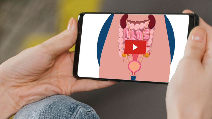 Animatie endometriose